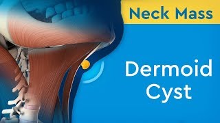 Neck Mass Dermoid Cyst [upl. by Philo]