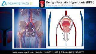 Prostate Artery Embolization PAE Explained [upl. by Ahsauqram]