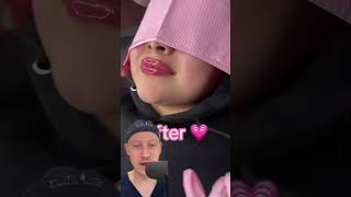 SHOCKING Before And After Lips Overfilled with Hyaluronic Acid  Plastic Surgeon Reacts [upl. by Nare85]