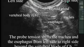 An ultrasound image of tracheal intubation [upl. by Anwahsad]