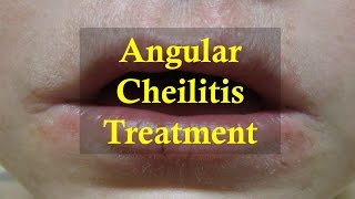 How to cure Angular Cheilitis Naturally [upl. by Oiciruam]