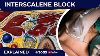 USGuided Interscalene Brachial Plexus Block  Regional anesthesia Crash course with Dr Hadzic [upl. by Yoshio]