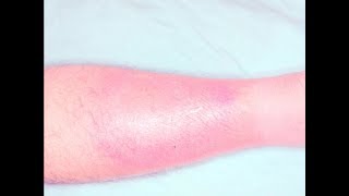 Necrotizing Fasciitis and Other Skin Infections [upl. by Fulmis]