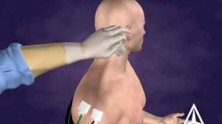 Botulinum Toxin B Injection Technique  3D Medical Animation [upl. by Bamby]