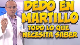 DEDO EN MARTILLO  Todo lo que necesita saber [upl. by Rawdin721]