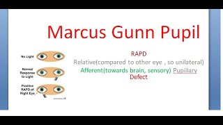 Ophthalmology Marcus Gunn Pupil RAPD Relative Afferent Pupillary Pathway Defect [upl. by Ainuj]