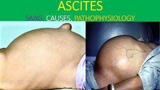 Ascites analysis explained [upl. by Aivila137]