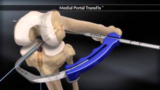 Medial Portal TransFix [upl. by Magocsi]