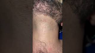 barber hairissue hair removingingrown hairproblem barbershop ingrownhair beard [upl. by Malilliw]