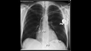 Cardiac Dyssynchrony  The Power of 2D Strain Imaging [upl. by Saref]