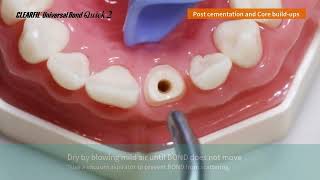 How to with UBQ 2 Post Cementation and Core Build Up [upl. by Manvel136]