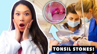 All About Tonsil Stones [upl. by Eirolam]