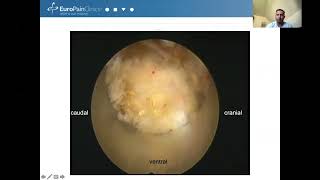 Endoscopic facet joint amp SI joint denervation initial experience [upl. by Kcub155]