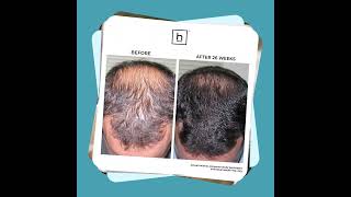 Hairmax® Laser Devices  take your hair from thinning to THRIVING [upl. by Greggory]