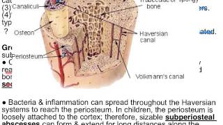 Osteomyelitis amp Pagets disease [upl. by Emirej]