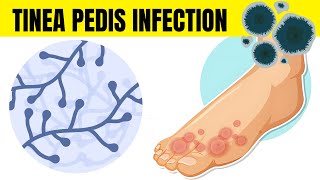 Tinea Pedis Infection Athletes Foot  Causes Types Signs amp Symptoms And Treatment [upl. by Bocaj]