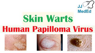 Overview of Skin Warts Verrucae  What Causes Them Who Gets Them  Subtypes and Treatment [upl. by Soo679]