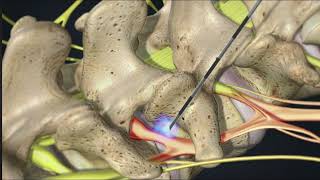 Transforaminal Root block injection [upl. by Ackerley]