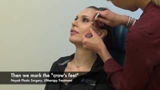 Ultherapy Treatment on Brow amp Crows Feet [upl. by Nivrek]