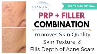 Acne Scar Treatment  Combining of PRP for Improved Skin Texture and Filler for Elevation [upl. by Sivrup]