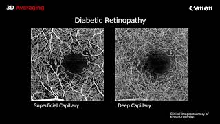 OCT Angiography with the OCT HS100 [upl. by Waal19]