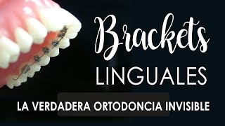 ESTO SI ES ORTODONCIA INVISIBLE BRACKETS LINGUALES [upl. by Liarret]