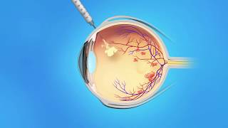 US Ophthalmic Retina Macular Edema Injection [upl. by Lonnie]