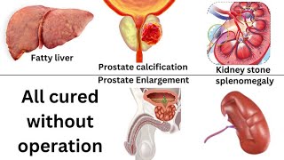 Case studies of Kidney stones Fatty liver prostatomegaly with calcification Renal Calculus etc [upl. by Nrubloc]