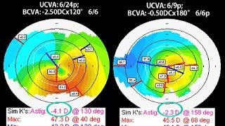 CAIRS A new technique for Keratoconus and corneal ecstasias [upl. by Origra854]