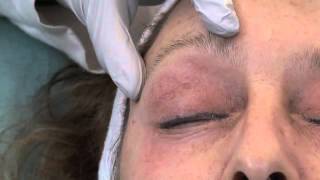 Dr Julie Edween Eye wrinkles treated with a Chemical Peel [upl. by Caplan]