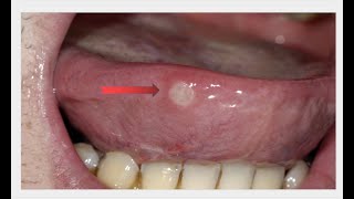 Tongue Ulcer Remedies treatment tonguecancer tonguecleaner ulcers cure care [upl. by Deming]