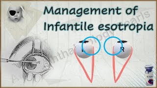 Infantile esotropia simplified 2│Management [upl. by Anidem872]