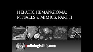 Hepatic Hemangioma Pitfalls amp Mimics Part II [upl. by Fachini]