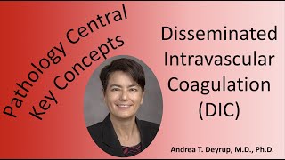 Medical School Pathology Pathophysiology of Disseminated Intravascular Coagulation DIC [upl. by Gurney]