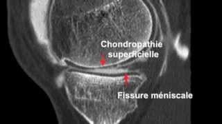 Chondropathie fémorotibiale et Arthroscanner [upl. by Chloette368]