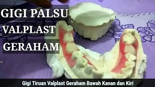 GIGI PALSU VALPLAST GIGI GERAHAM BAWAH [upl. by Nnylimaj174]