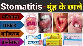 Stomatitis  मुंह के छाले का इलाज  Mouth Ulcer Treatment  Stomatitis In Hindi Muh Ke Chale Ka Ilaj [upl. by Illak]