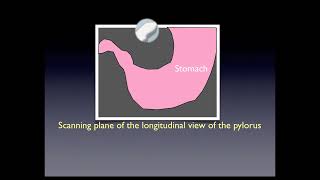 Pyloric Stenosis [upl. by Cleres]