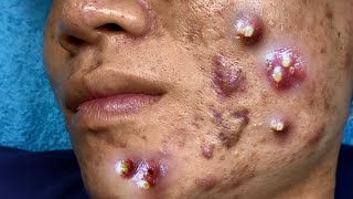 Big Cystic Acne Blackheads Extraction Blackheads amp Milia Whiteheads Removal Pimple Popping 095 [upl. by Eenahpets]