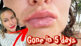 Angular Cheilitis gone in 5 daysLip eczemacracked lips red corners mouth SHOCKING FAST RESULTS [upl. by Ordway]