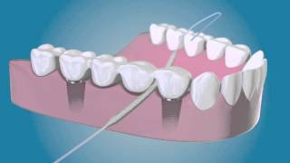 Bridge And Implant Floss by TePe [upl. by Sorci]