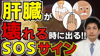 【放置厳禁】絶対見逃してはいけない肝臓が壊れる時に現れる危険サイン14選。皮膚の異常だけではなく●●も危険なので気をつけて！【がん専門医が語る】 [upl. by Eednyl]