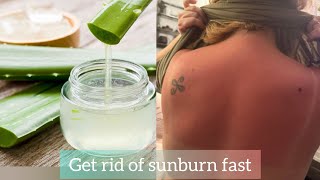 How to get rid of sunburn fast  sunburn treatment at home [upl. by Kidder432]