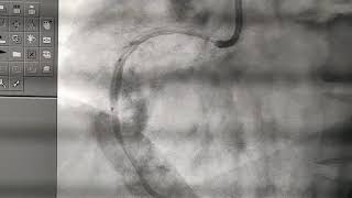 Perforation of coronary [upl. by Dunston]