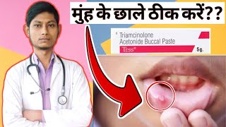 Triamcinolone oromucosal paste bp 01 ww  मुंह के छाले ठीक करें  Oraways paste in hindi [upl. by Eelreveb]