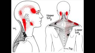 Safe Technique for Dry Needling Trapezius Trigger Point [upl. by Musette]