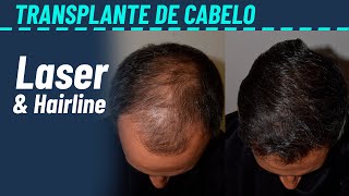 Transplante capilar depois de 7 meses  Hairline e laser [upl. by Elleinwad151]