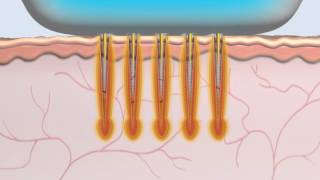 Animation Radiofréquence MicroNeedle Secret [upl. by Ybbob]