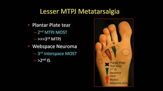 Forefoot and Midfoot Sources of Pain [upl. by Niajneb]