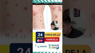 VIRUS DE LA VARICELA EN PEDIATRÍA [upl. by Nnor]